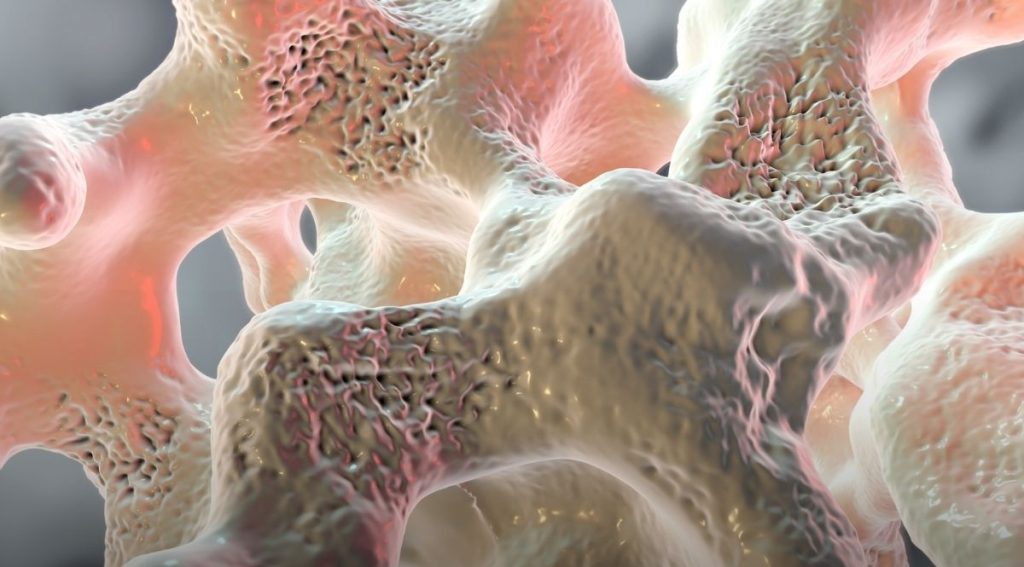 Osteoporoz Kemik Erimesi Tanı ve Takibi - Doç. Dr. Mehmet Bankir